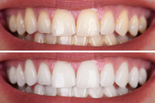 Pros y contras de un blanqueamiento dental profesional